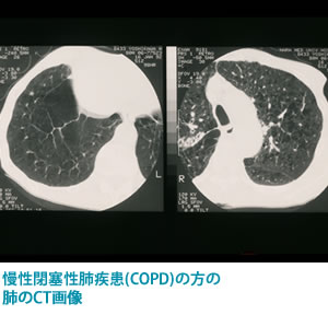 慢性閉塞性肺疾患(COPD)の方の肺のレントゲン写真