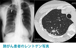 肺がん患者のレントゲン写真